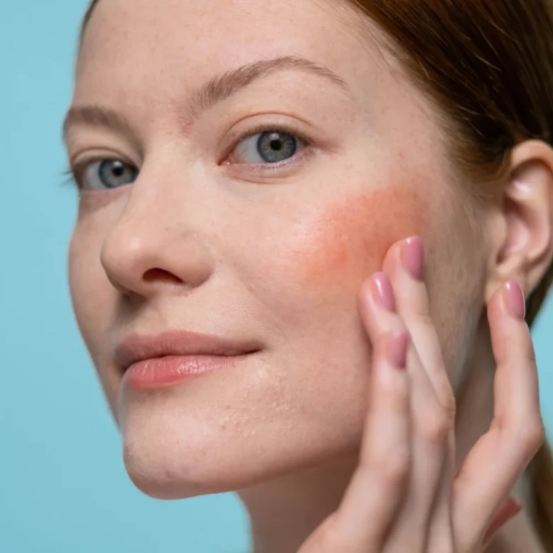 Common Eczema Myths You Need to Know