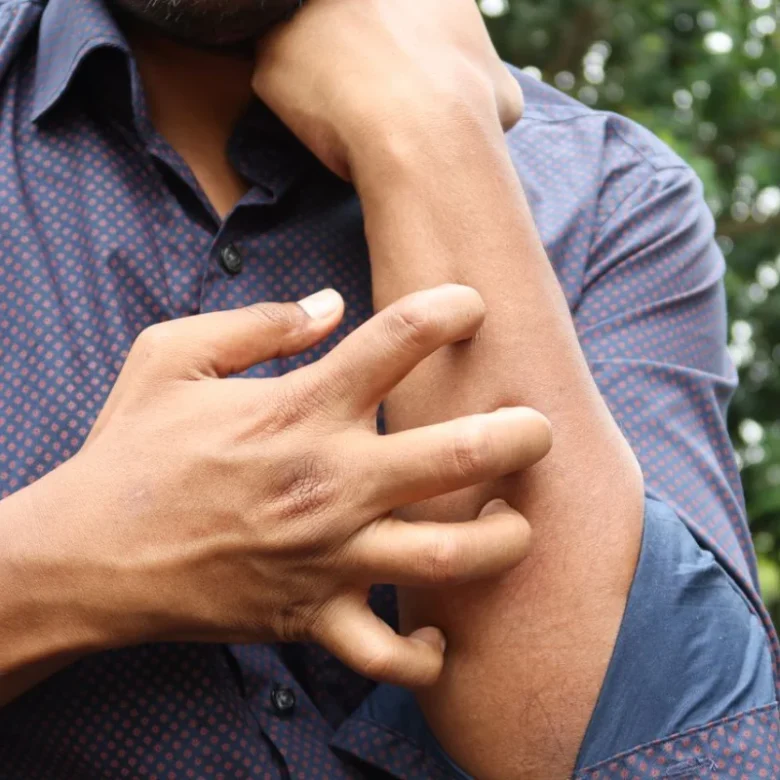 Heal Eczema Naturally: It’s More Than Skin Deep