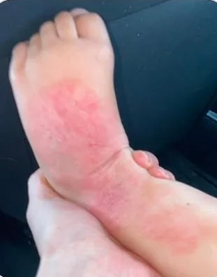 infant foot with eczema