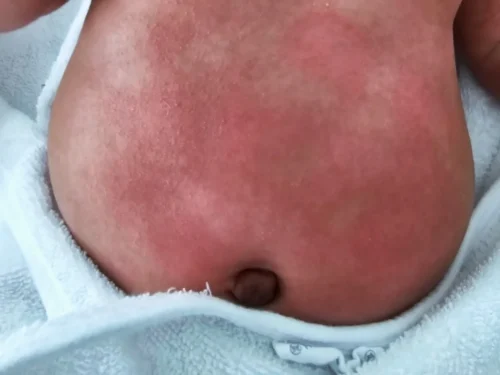 infant torso with eczema